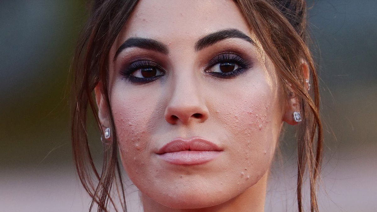 Foto Giulia De Lellis acne problema